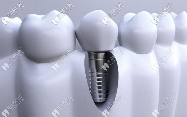 韓國(guó)登騰Dentium種植體的優(yōu)點(diǎn)