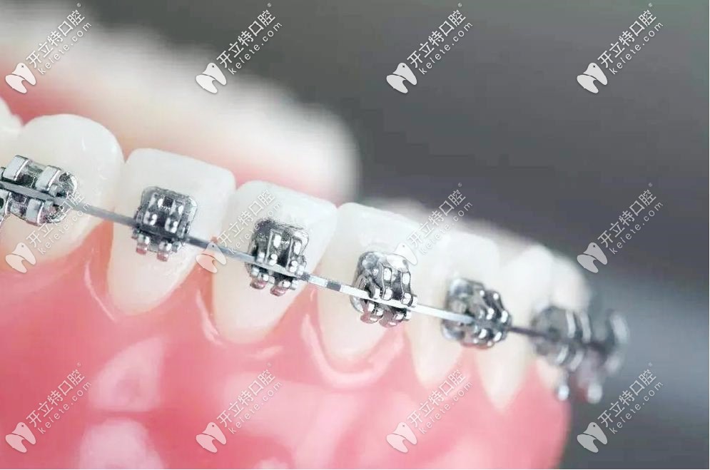 gac自鎖托槽是哪里產(chǎn)的，用gac自鎖牙套矯正到底好不好？