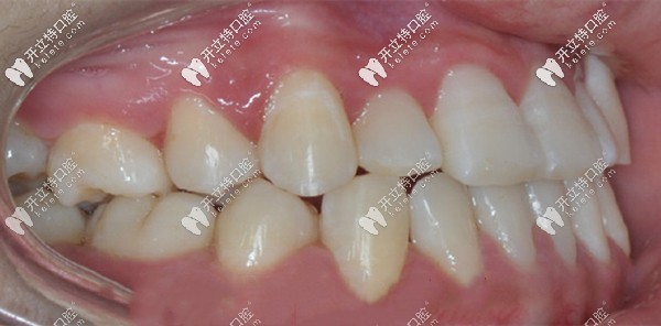 地包天做完掩飾性正畸的效果
