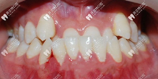 重度骨性牙頜畸形做掩飾性正畸的效果不會(huì)很理想