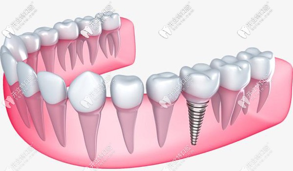 韓國(guó)紐百特neo種植體的優(yōu)點(diǎn)