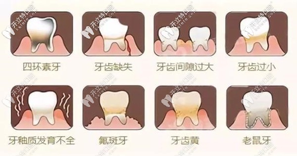 合肥貝杰口腔全瓷貼面修復(fù)的優(yōu)點