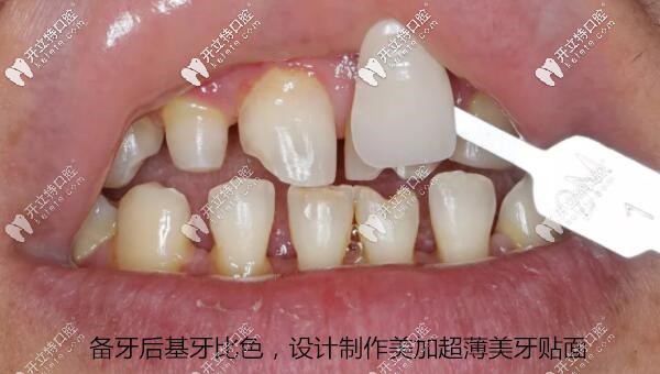 備牙后基牙比色，設(shè)計(jì)制作美加超薄美牙貼面