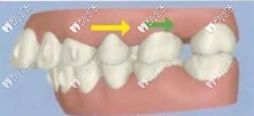 金屬自鎖牙套可以磨牙后推嗎?磨牙后移只有隱形牙套可以做?