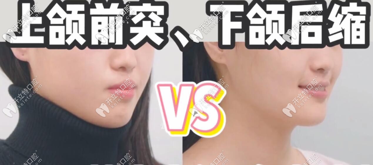 我算是牙槽骨薄的成功矯正案例,很感謝我的正畸醫(yī)生李蓮鶴