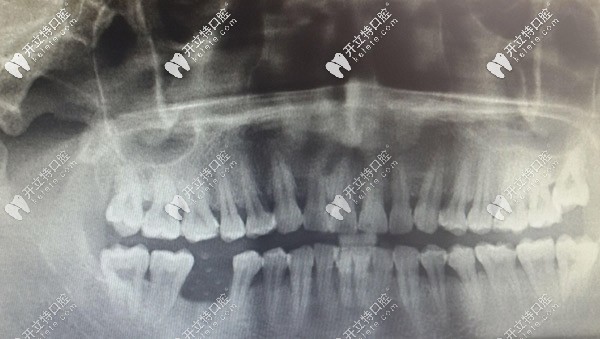 被拔除后牙齒牙窩有膿液