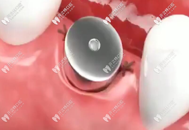 安裝愈合基臺，縫合傷