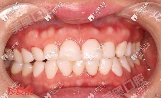 美容院做的5D浮雕牙貼面真坑,感謝西安美奧口腔拆除修復好