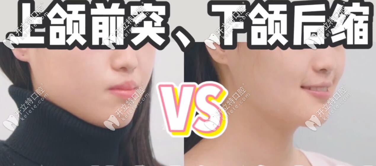 嘴巴前突矯正前后側(cè)臉效果對(duì)比