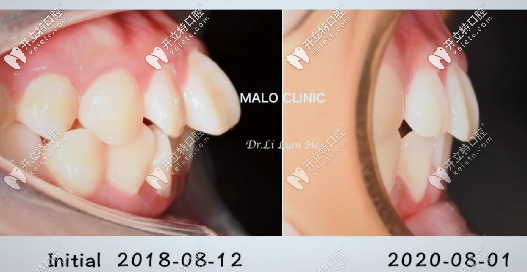 左圖為矯正前，牙齒根部凸起像骨頭一樣