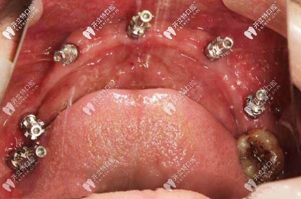 下頜植入6顆種植體的口內圖