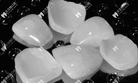 烤瓷,鑄瓷及聚合瓷貼面的區(qū)別及價格介紹,哪個好一目了然