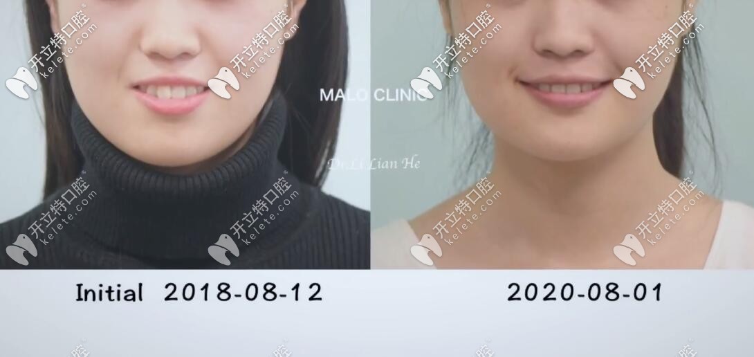 齙牙矯正前后我的臉型對(duì)比圖