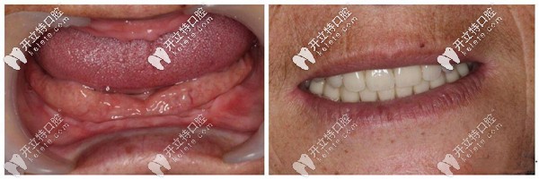 全口吸附性假牙案例