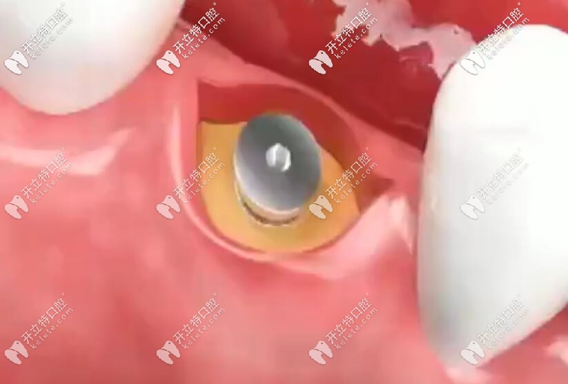 切開牙齦取覆蓋基臺
