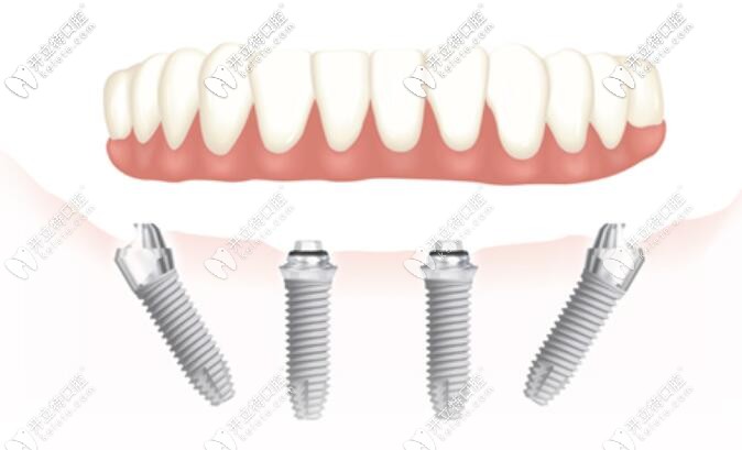 ALL-ON-4種植牙 ALL-ON-4種植牙