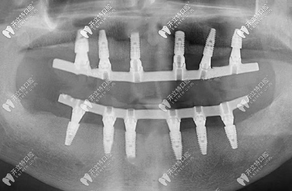 all-on-six即刻種植牙的全景片