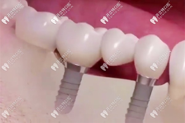 種植牙用二顆釘裝三顆牙冠