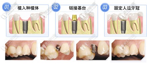 做種植牙二期手術(shù)過程