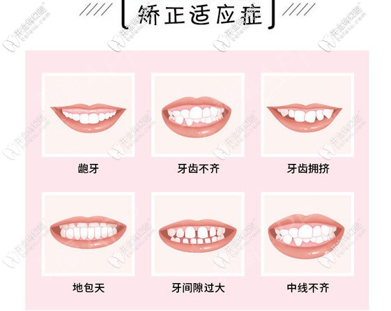 哪些牙齒要做牙齒矯正呢？請對號入座！