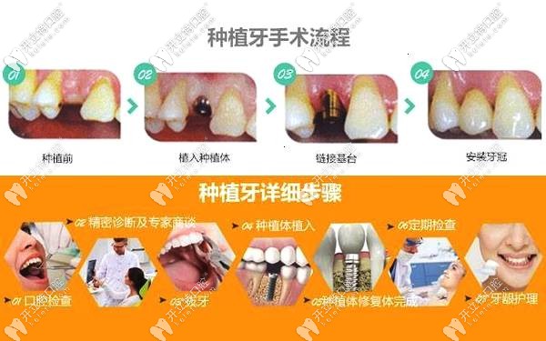 超詳細(xì)的種植牙二期上基臺步驟