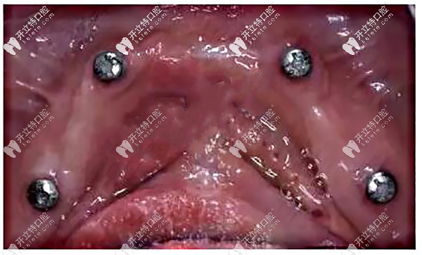 allon4下半口種植牙植入