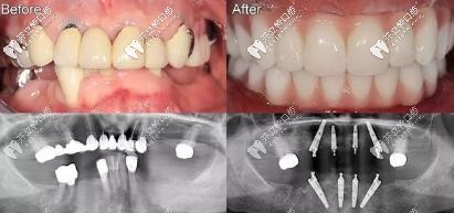 全口all-on-4即刻種植