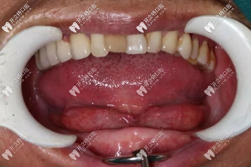 下半口牙齒缺失