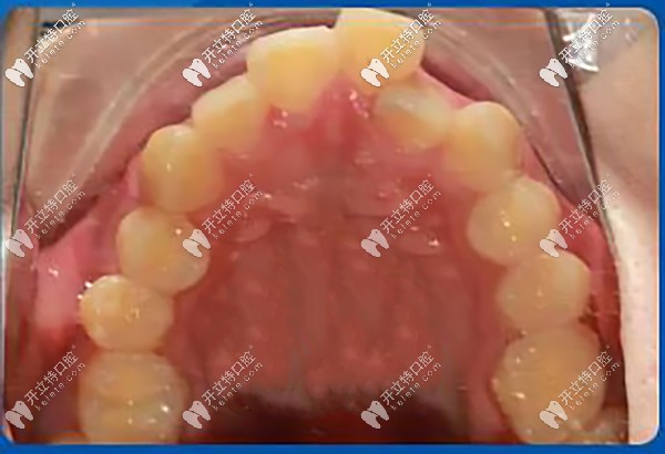 牙齒重度擁擠不齊，牙弓狹窄