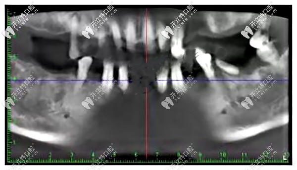 種植手術(shù)前的拍的CT牙片