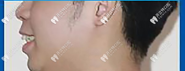 側(cè)面顯凸嘴，唇型厚重，唇肌緊張