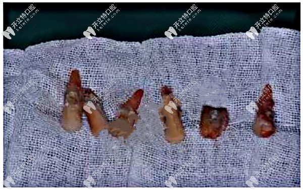 牙齒遺 留的殘根、松動牙齒拔除掉