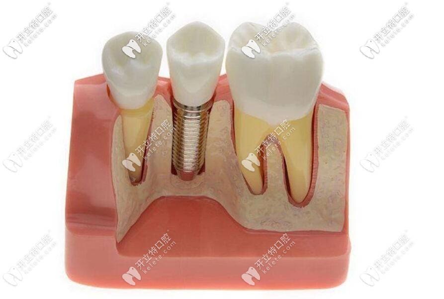 種植體材料 種植體材料