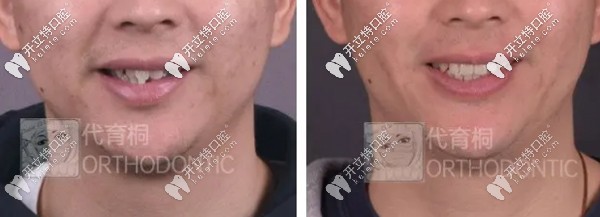 代育桐醫(yī)生矯正案例一