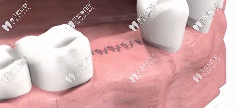 在縫合傷口后，經(jīng)過時(shí)間愈合：7天左右即可拆線