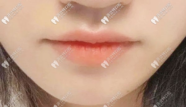 正畸結(jié)束一年后嘴唇變化圖