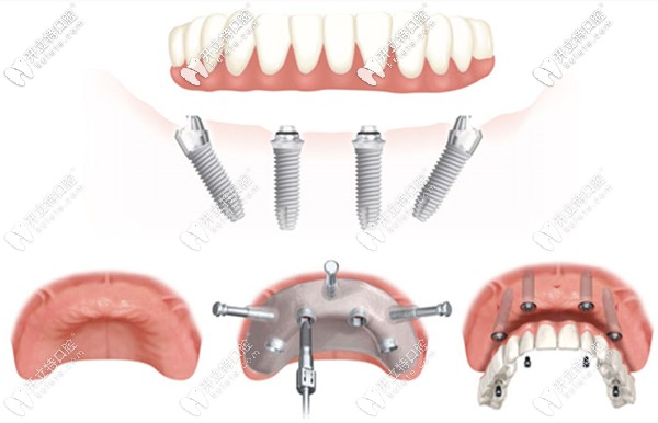 廣州馬瀧齒科的種植牙特色技術(shù)