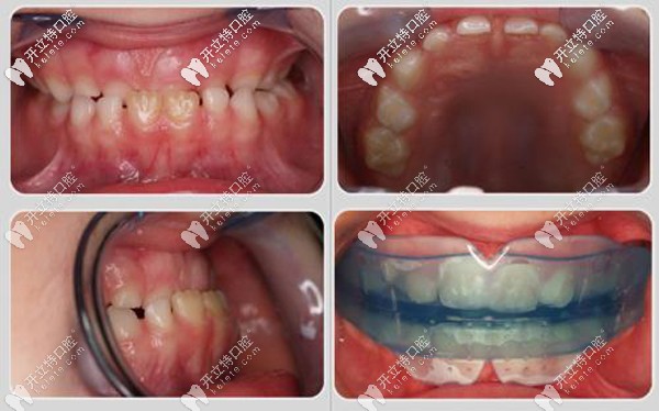 美奧口腔朱峰兒童矯正
