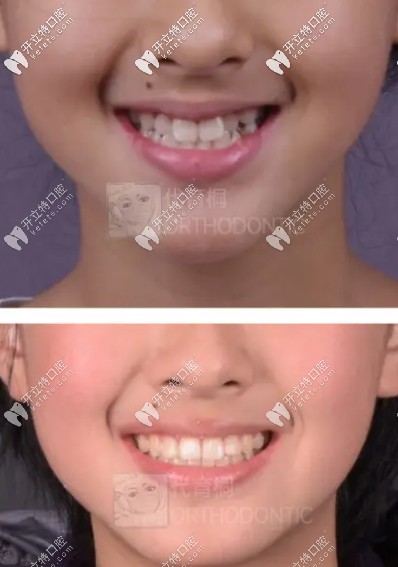 代育桐醫(yī)生矯正案例三