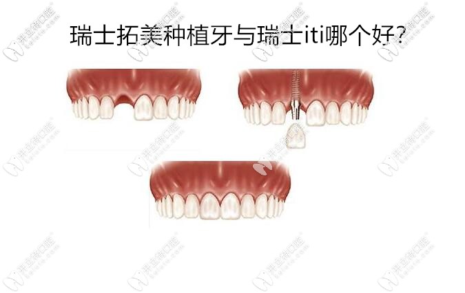 瑞士拓美種植牙15000的價格貴不貴,thommen與瑞士ITI哪個好