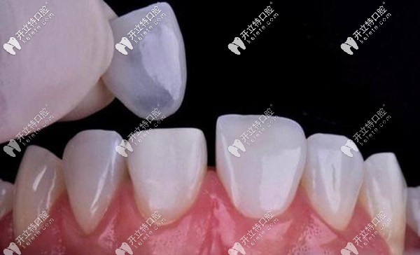 拆掉后可做牙貼面