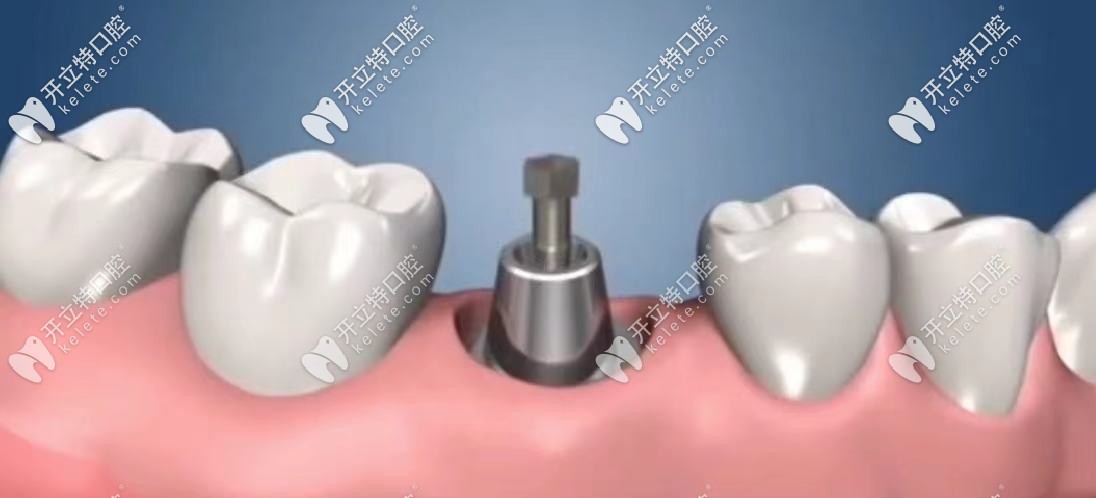 卸掉螺釘，換上鈦金屬的連接基臺(tái)