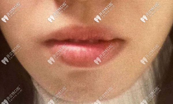 做矯正前的正面唇部照