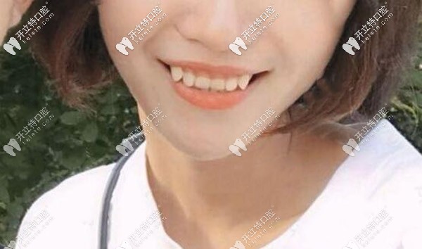 牙齒內傾導致深覆合,看我牙內扣正畸后的效果圖