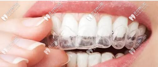 牙齒保持器哪種成效好?對比哈雷/透明/舌側(cè)保持器優(yōu)缺點