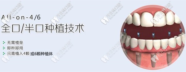 半口牙種植幾顆植體合適,是4顆好還是6顆好呢?價錢一樣不