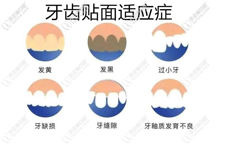 牙齒貼面一顆4000貴嗎?我門牙牙縫大2mm做牙齒貼牙片多少錢