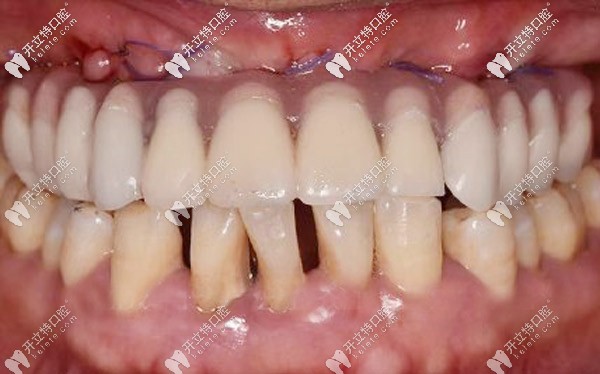 做的義齒帶上去也很合適 做的義齒帶上去也很合適
