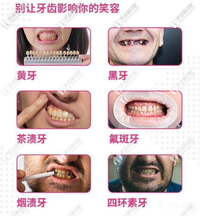 哪些牙齒問題可以做冷光美白