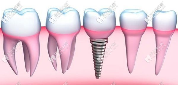 拔完牙后多久可以種植牙?其實(shí)拔牙后做種植的時(shí)間因人而異